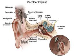 Cost of Cochlear Implant in India